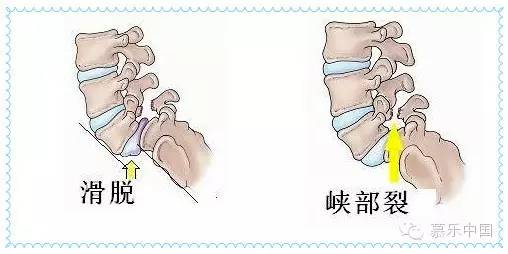 【运动防护】椎弓骨折和腰椎关节脱位