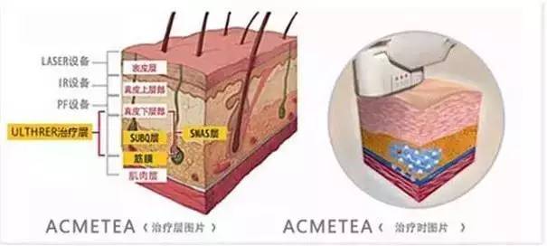 美容超声刀原理是什么_白带是什么图片