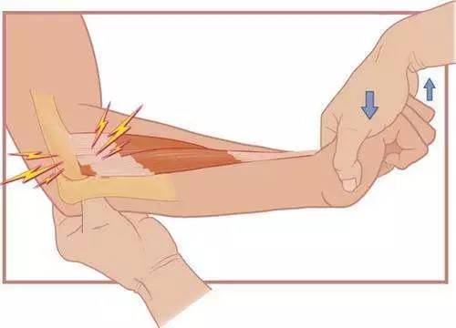 网球肘(肱骨外上髁炎)是肘关节外侧前臂伸肌起点处肌腱发炎疼痛.