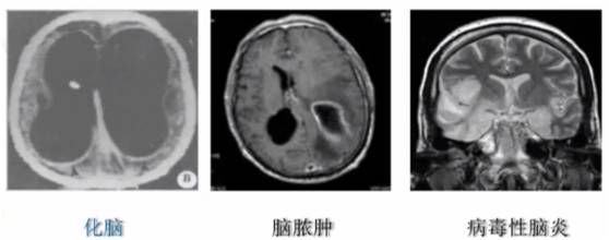 正文  儿科神经系统感染非常常见,而小儿颅内感染包括化脓性脑膜炎,脑