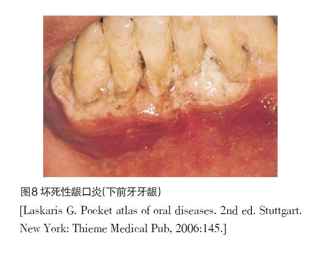 aids患者和hiv携带者很多存在口腔病损,你能发现它们