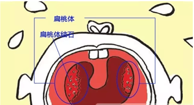 偶尔咳出米白色恶臭颗粒是怎么回事?