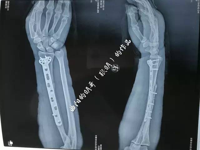 骨哥手术课堂:桡骨下段骨折微创钢板接骨术演
