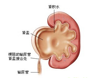 李俪医生:肾积水饮食有什么需要注意的