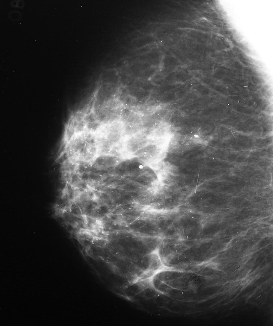 几张X光片,教你看乳房健康