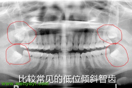 为什么我会长智齿