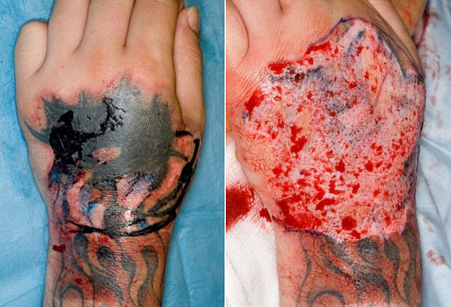 纹身引起的惨案:纹身容易去除难,不要轻易纹身