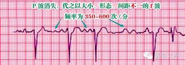 这样教你看心电图,没有理由看不懂 !