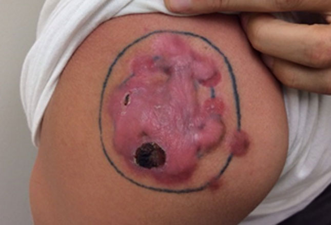 这张照片显示的是一位23岁的患者,在纹身处感染了珍珠状丘疹