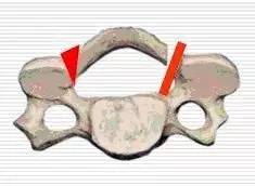 试试微型钛板做颈椎后路单开门术