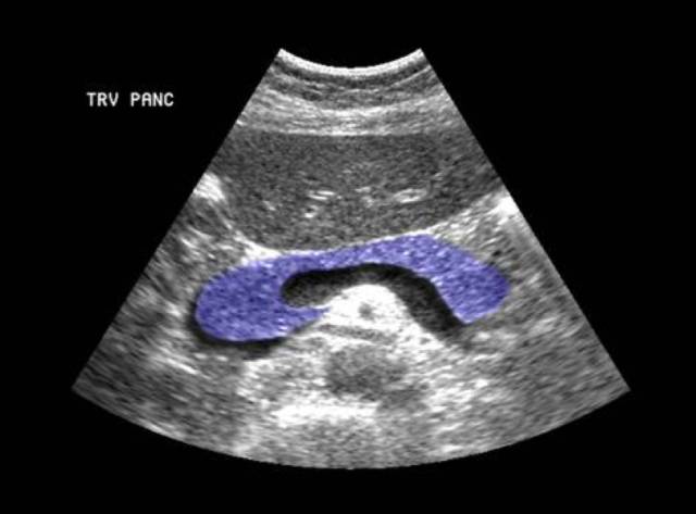 超声检查下的胰腺