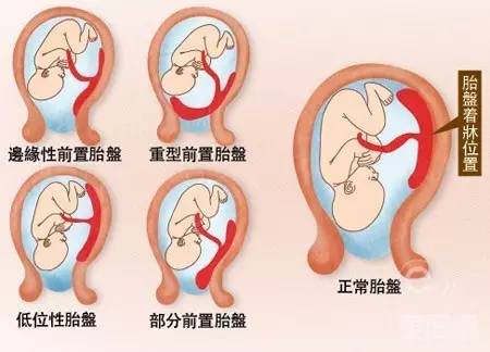 边缘性前置胎盘:胎盘处于子宫的下段,胎盘到达子宫颈口,但尚未完全