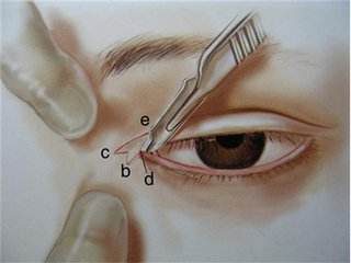 开眼角手术失败导致眼睛闭不上