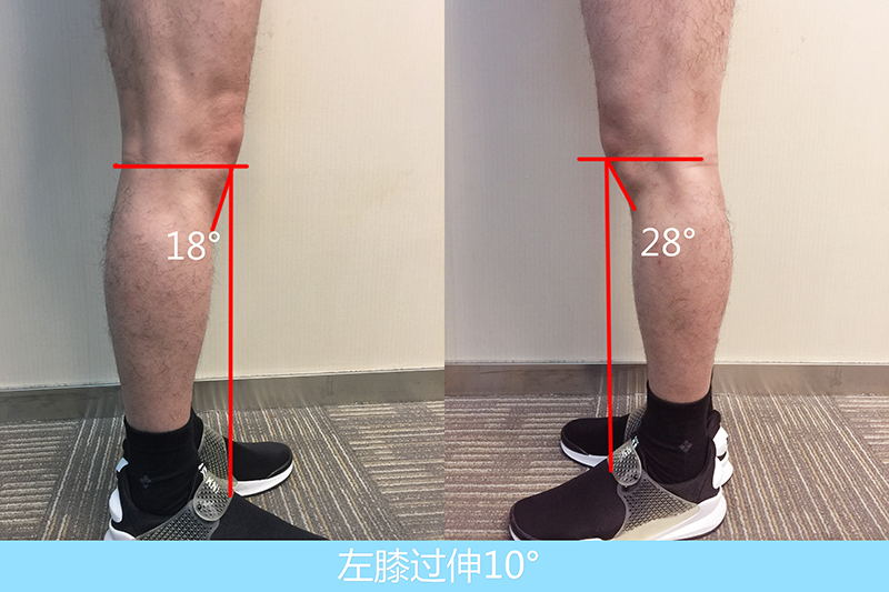 原来是膝关节损伤后导致下肢力线偏移