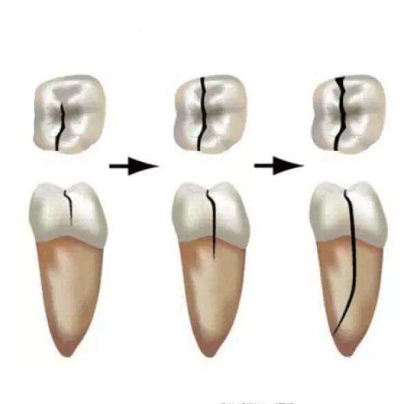 牙齿裂缝周围开始变黑,这颗牙还能留住吗?