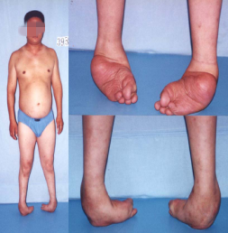 也可能是足内翻用脚背外侧走路等,也是常见的小儿麻痹后遗症的症状
