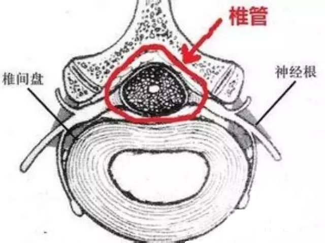 椎管内肿瘤≠脊柱肿瘤,患病后应该到神经外科看!