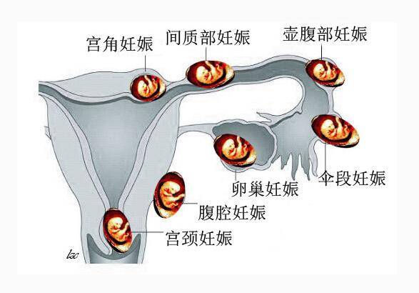 健康大姨妈来了还能怀孕有一种月经不调叫异位妊娠