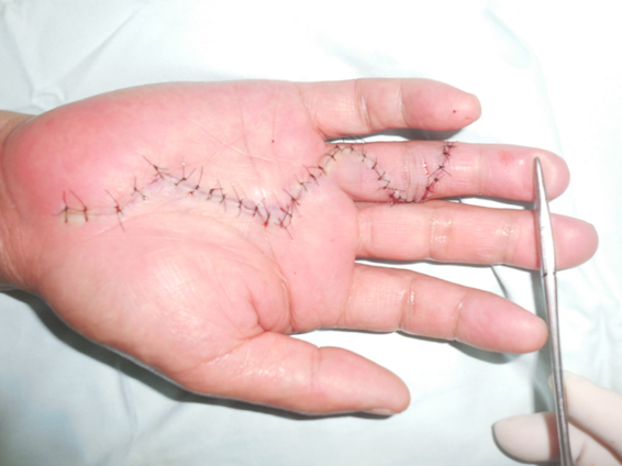 据介绍,掌腱膜挛缩症(dupuytren" s contracture)是一种侵犯掌腱膜