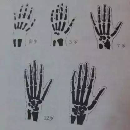 儿童手部骨骼发育图