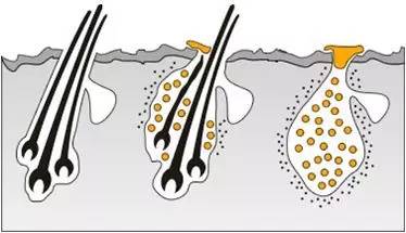 健康的毛囊皮脂腺,大汗腺都是健康状态,毛发也处于平衡状态.