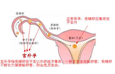 异位妊娠