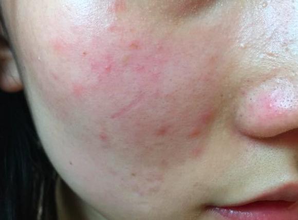 鉴别方法:皮肤大片的红斑,痒,有些逆光可见的"皮里肉外"的斑丘疹