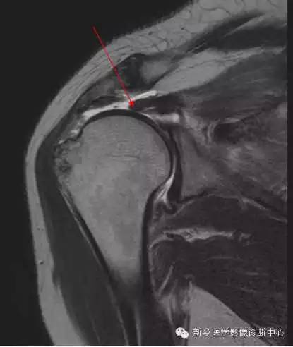 一文读懂肩袖损伤的磁共振分级!