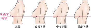 如果胸部轻微下垂,可采用日常方法来改善