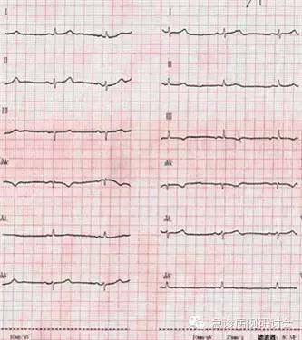 右半部分为左侧上下肢导联反接的心电图
