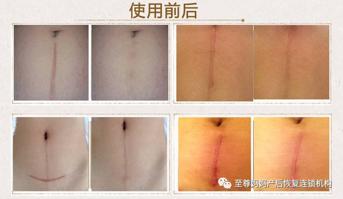 剖腹产后如何减少创面疤痕