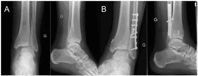 下胫腓联合损伤的3种手术固定方式剖析踝关节