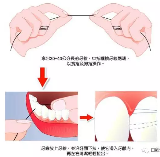 牙签断在牙洞里怎么办