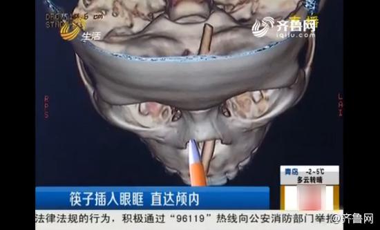 男童摔倒两根筷子插入鼻腔 差1毫米刺破眼球(组图)