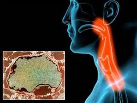 咽喉癌症状有哪些表现如何调理