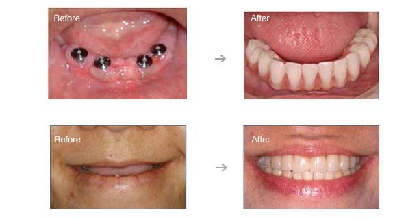 2,不磨牙 依靠自身的人工牙根进行修复,不用磨旁边的健康牙齿,避免基