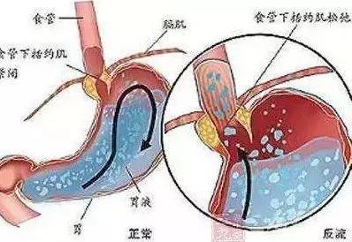 总是反酸该怎么办