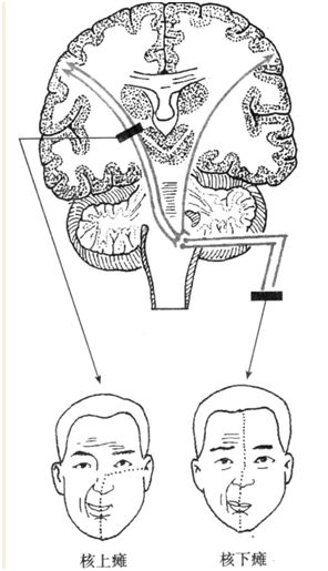 临床医学基础知识:核上瘫与核下瘫