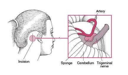 面肌痉挛 的微创 导航下微血管减压术