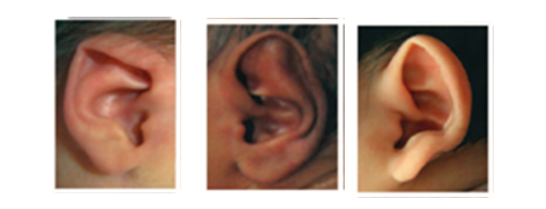因耳廓萎缩或发育不良导致的皮肤或软骨组织缺失;   形态畸形:耳廓
