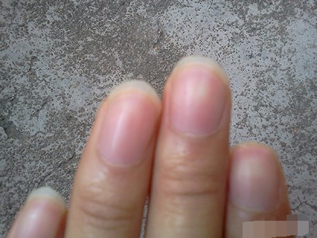 6种指甲形状看出身体大隐患