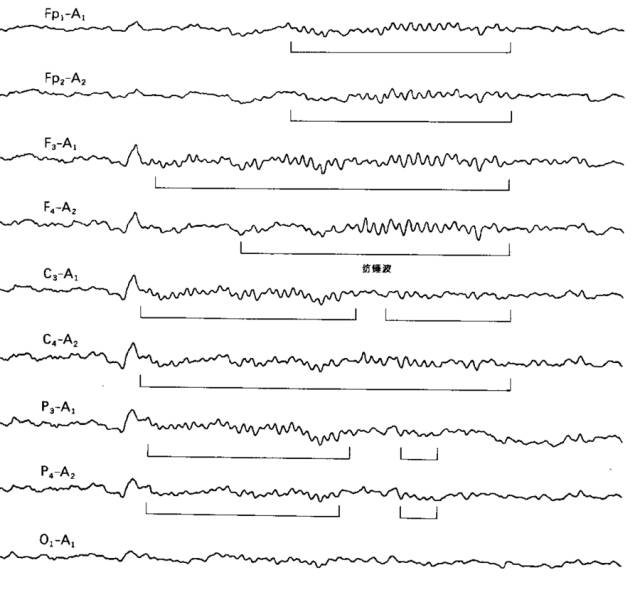有两个特征性的波:k复合波和睡眠纺锤波.