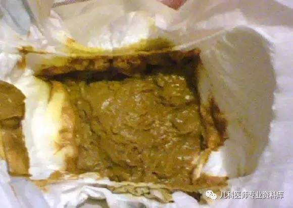 高能预警!宝宝大便色,味,形,奶瓣,泡沫,黏液大全