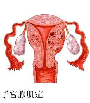 故有子宫内子宫内膜异位症之称,而盆腔内子宫内膜异位症则称为子宫外