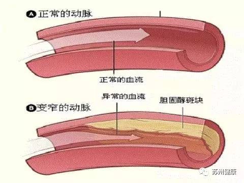 三分之一的中国人这里有斑块,一旦发生凶险无比!别再