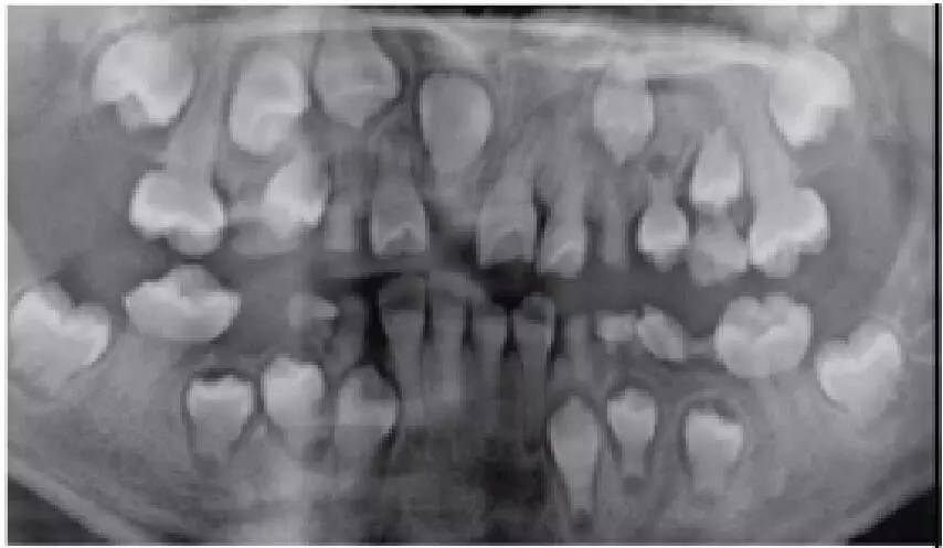 【非龋性牙体硬组织疾病】牙体发育异常临床诊