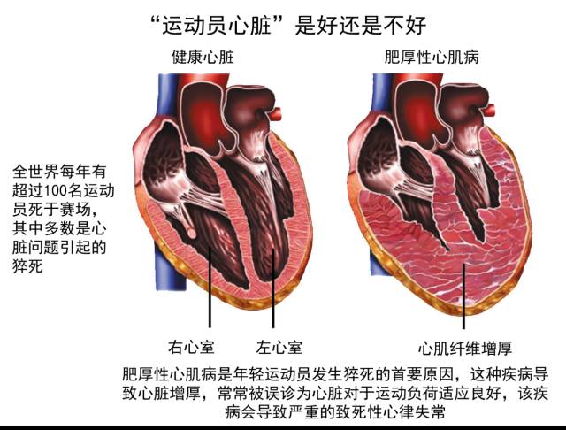 一精英跑者因心肌梗塞离世:长期大强度跑步可能对心脏不全是好处