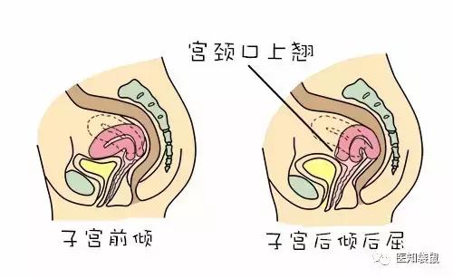 子宫前位,后位,女人哪种子宫最易受孕?