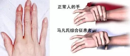 12岁女孩几近失明,原来是马凡氏综合征惹的祸