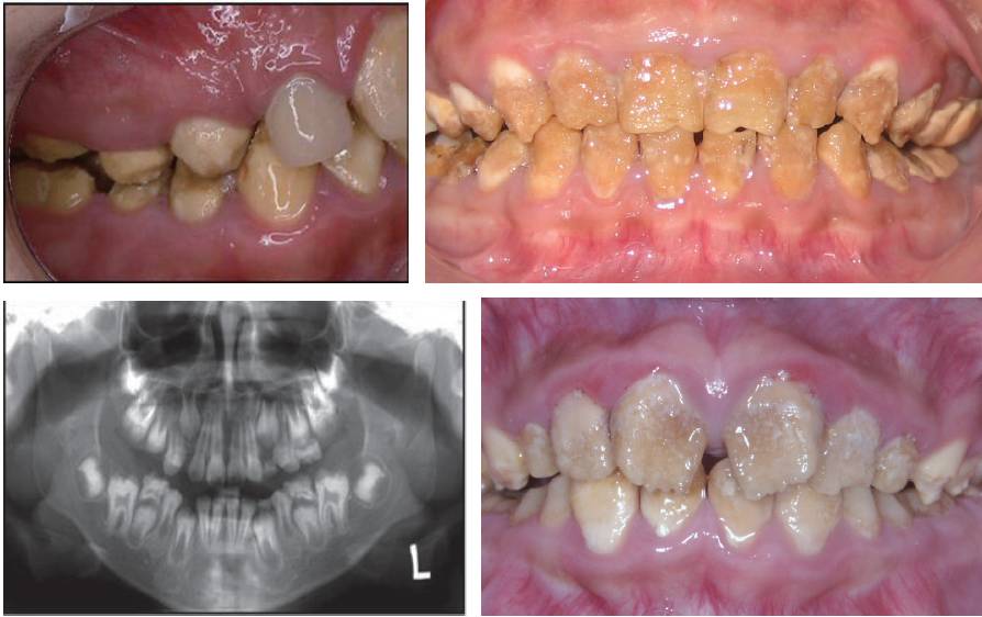 釉质发育不全的诊断与牙体发育异常的治疗——宋亚玲